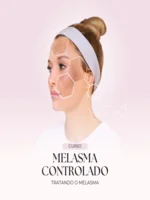 Melasma Controlado