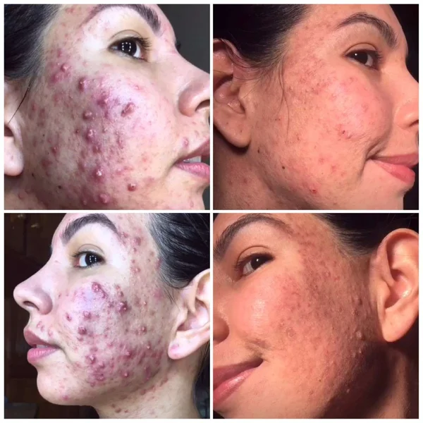 Resultados reais de alunas da comunidade antiacne