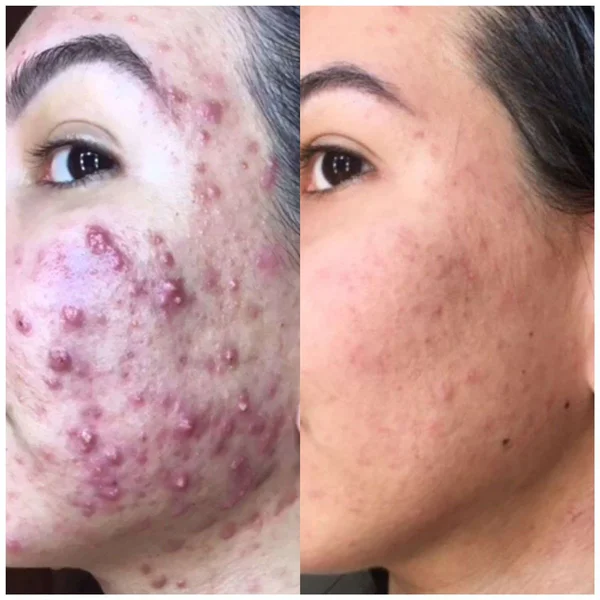 Resultados reais de alunas da comunidade antiacne